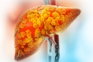 The Hidden Truth About Fatty Liver You Should Be Aware Of